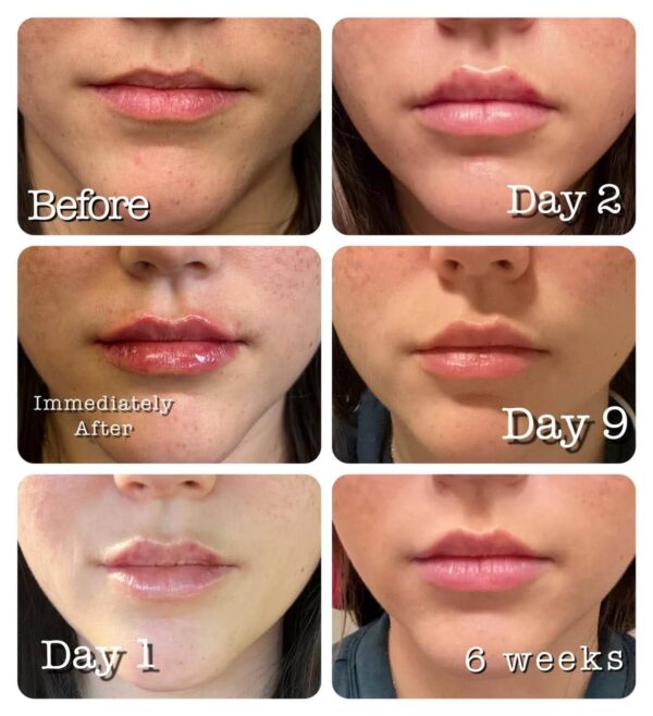 lip-filler-swelling-stages-central-texas-dermatology