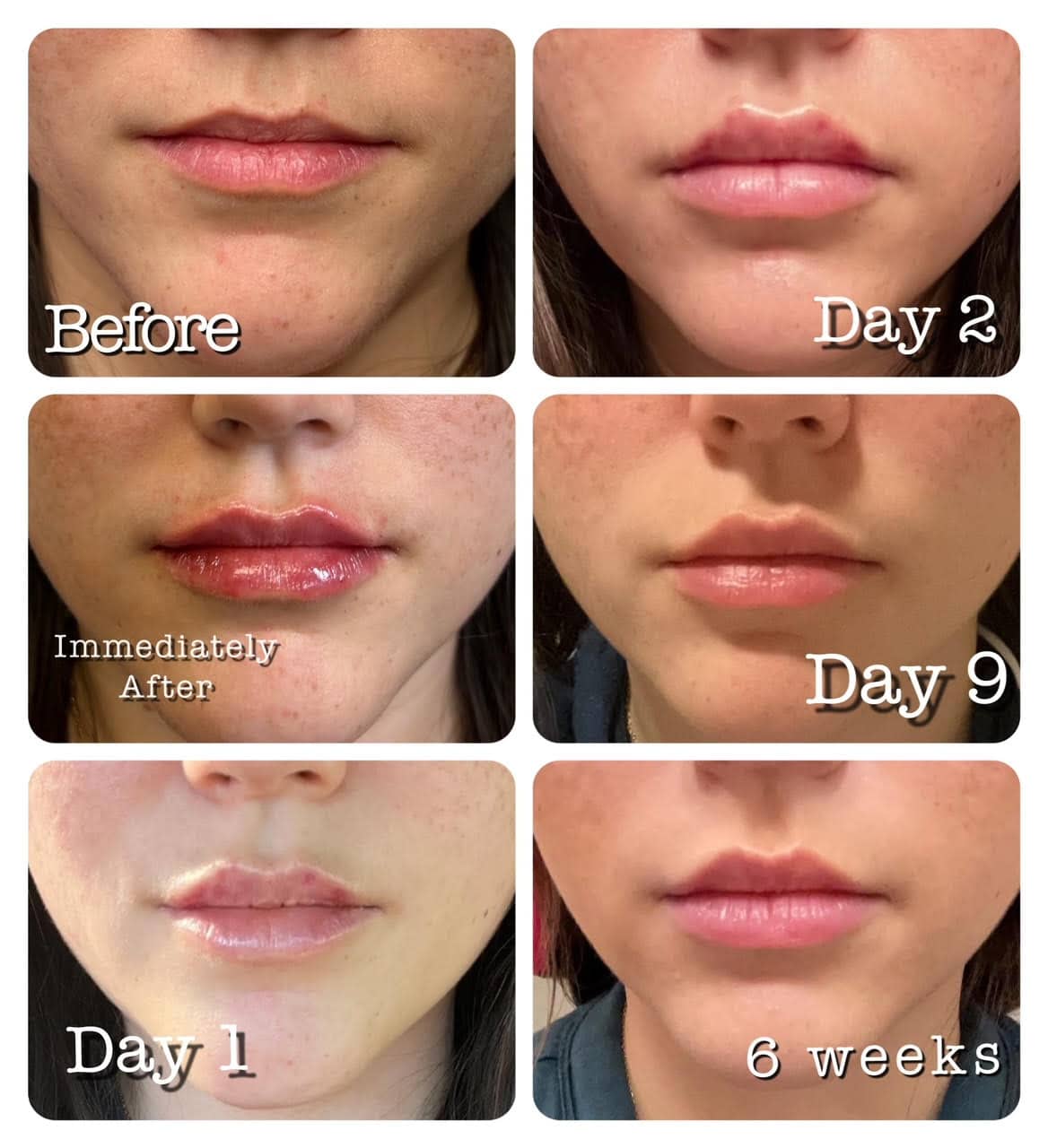 lip injections before and after